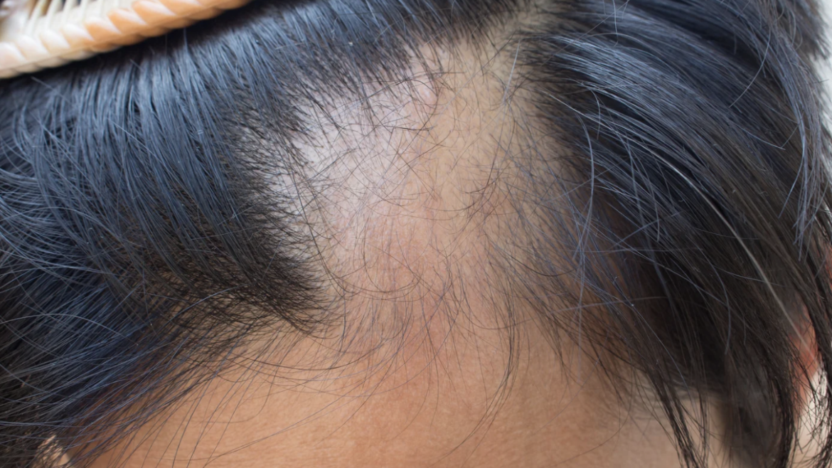 Top 5 Reasons for Hair Loss and What You Can Do About It